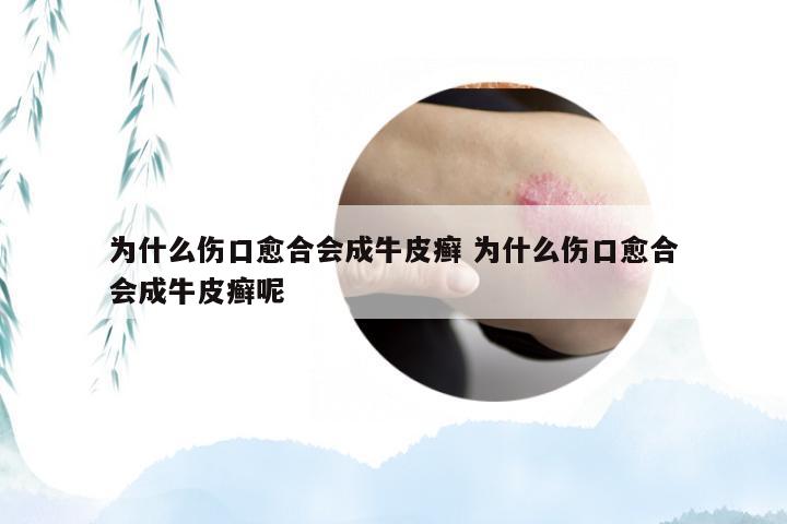 为什么伤口愈合会成牛皮癣 为什么伤口愈合会成牛皮癣呢