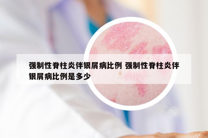 强制性脊柱炎伴银屑病比例 强制性脊柱炎伴银屑病比例是多少