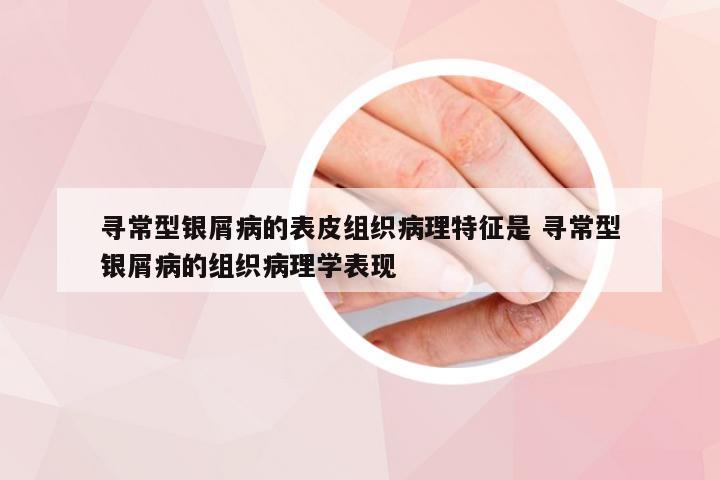 寻常型银屑病的表皮组织病理特征是 寻常型银屑病的组织病理学表现