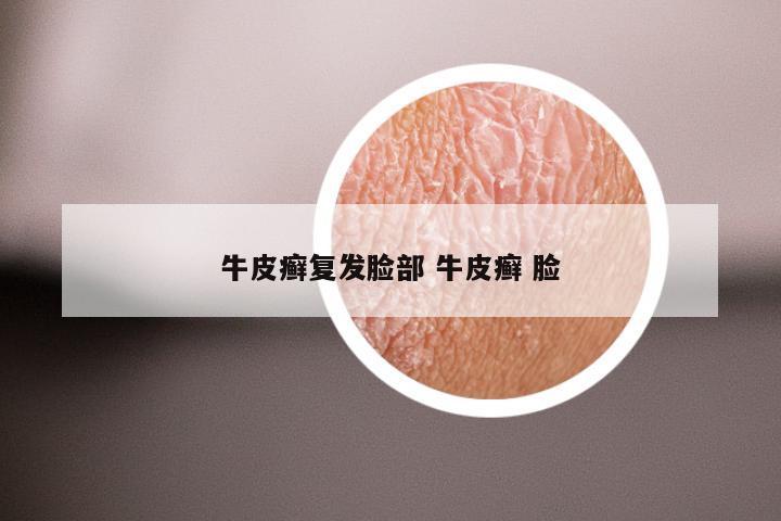 牛皮癣复发脸部 牛皮癣 脸