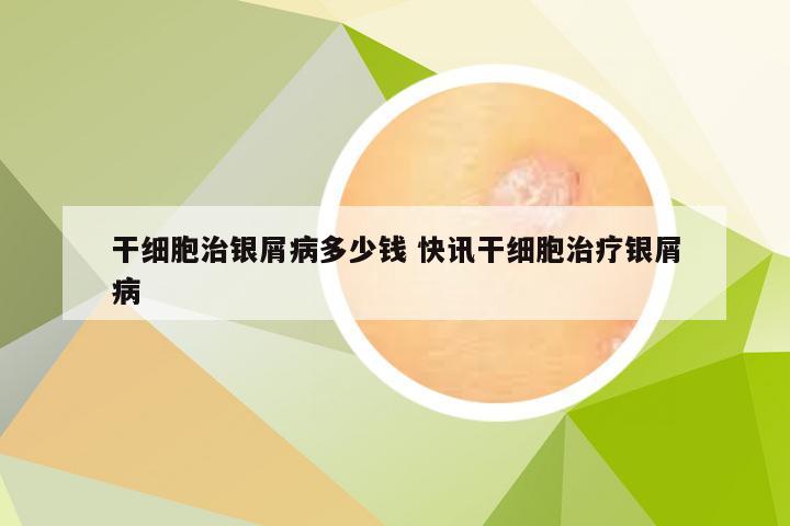 干细胞治银屑病多少钱 快讯干细胞治疗银屑病
