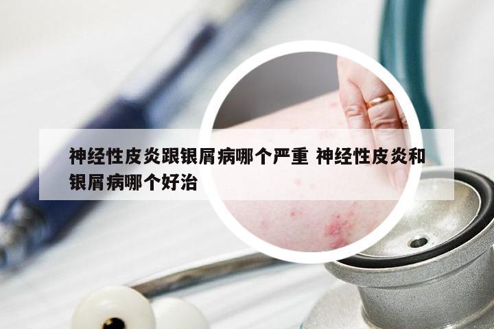 神经性皮炎跟银屑病哪个严重 神经性皮炎和银屑病哪个好治