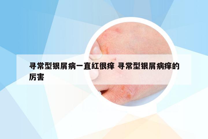 寻常型银屑病一直红很痒 寻常型银屑病痒的厉害