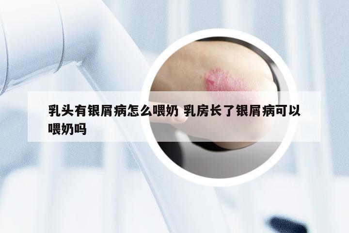乳头有银屑病怎么喂奶 乳房长了银屑病可以喂奶吗