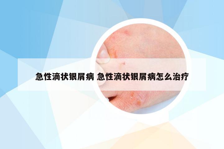 急性滴状银屑病 急性滴状银屑病怎么治疗