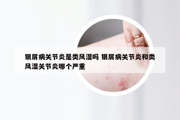 银屑病关节炎是类风湿吗 银屑病关节炎和类风湿关节炎哪个严重