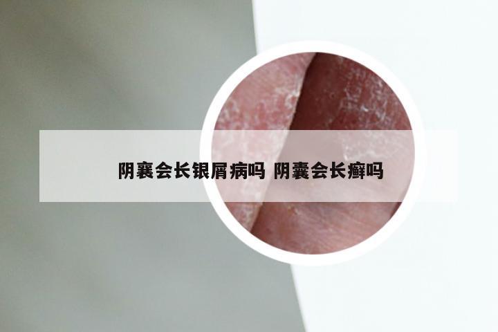 阴襄会长银屑病吗 阴囊会长癣吗