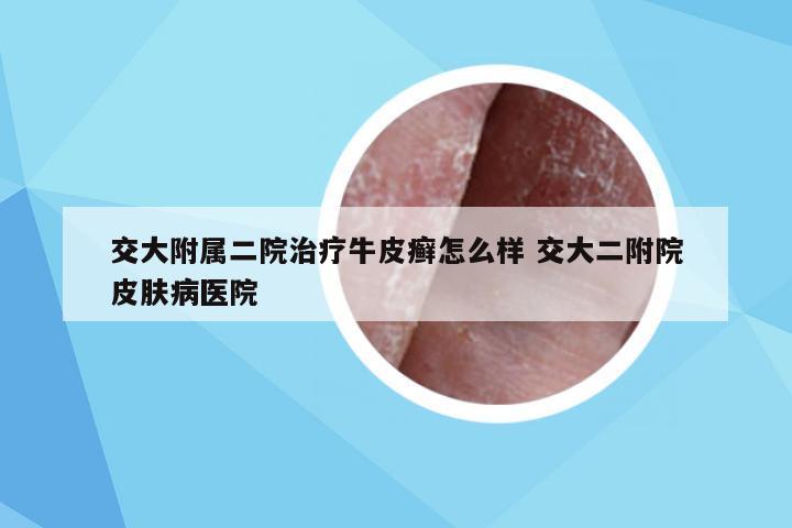 交大附属二院治疗牛皮癣怎么样 交大二附院皮肤病医院