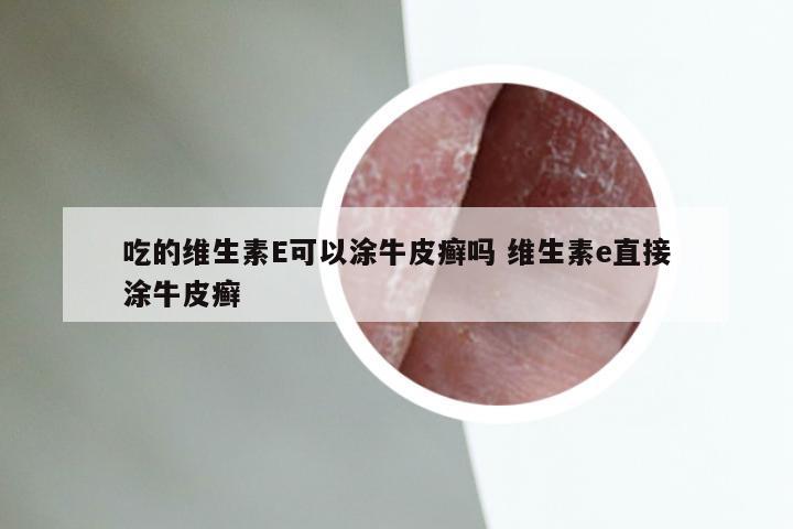 吃的维生素E可以涂牛皮癣吗 维生素e直接涂牛皮癣