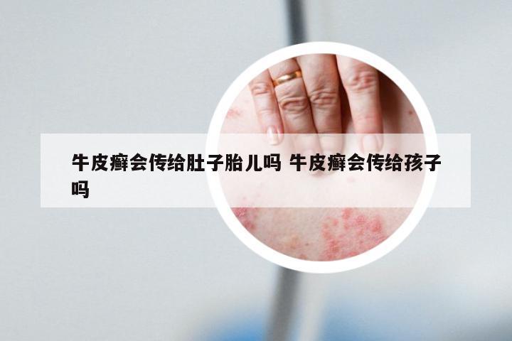 牛皮癣会传给肚子胎儿吗 牛皮癣会传给孩子吗