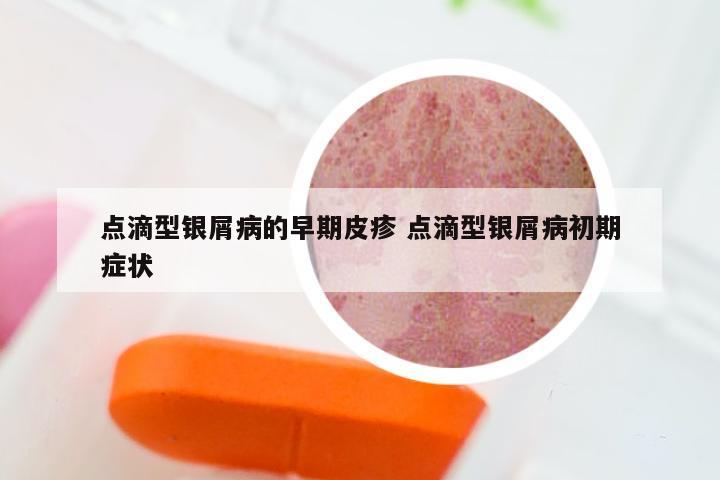 点滴型银屑病的早期皮疹 点滴型银屑病初期症状