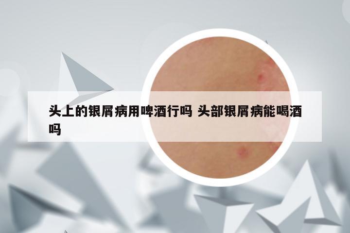 头上的银屑病用啤酒行吗 头部银屑病能喝酒吗