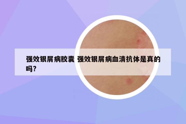 强效银屑病胶囊 强效银屑病血清抗体是真的吗?