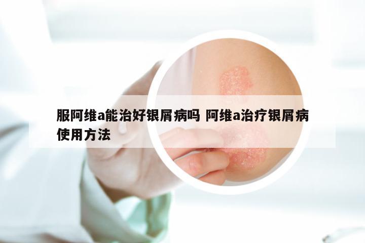 服阿维a能治好银屑病吗 阿维a治疗银屑病使用方法