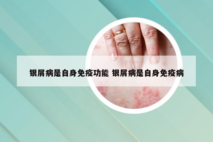 银屑病是自身免疫功能 银屑病是自身免疫病