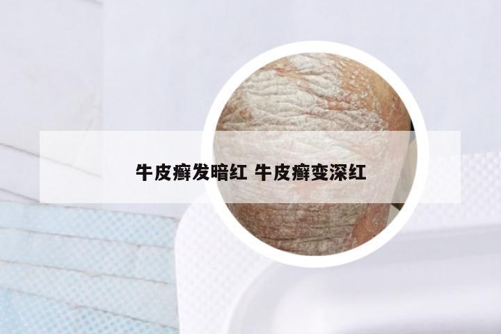 牛皮癣发暗红 牛皮癣变深红