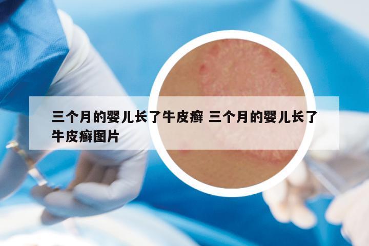 三个月的婴儿长了牛皮癣 三个月的婴儿长了牛皮癣图片