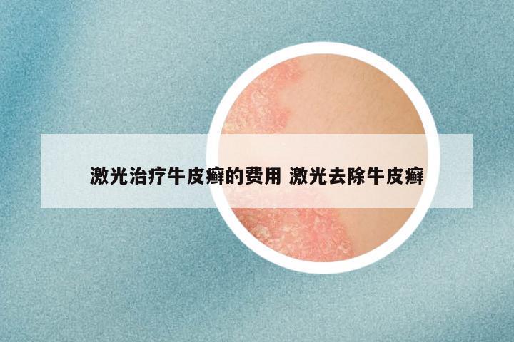 激光治疗牛皮癣的费用 激光去除牛皮癣