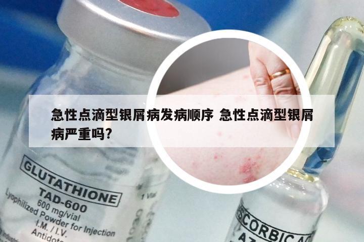 急性点滴型银屑病发病顺序 急性点滴型银屑病严重吗?
