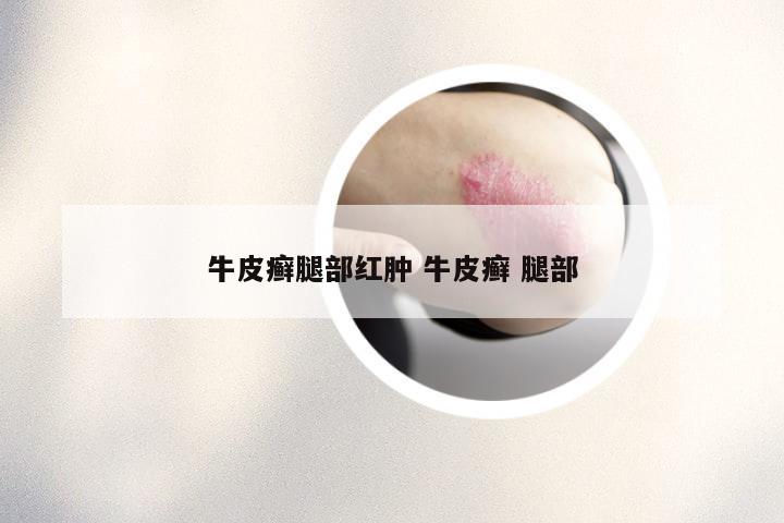 牛皮癣腿部红肿 牛皮癣 腿部