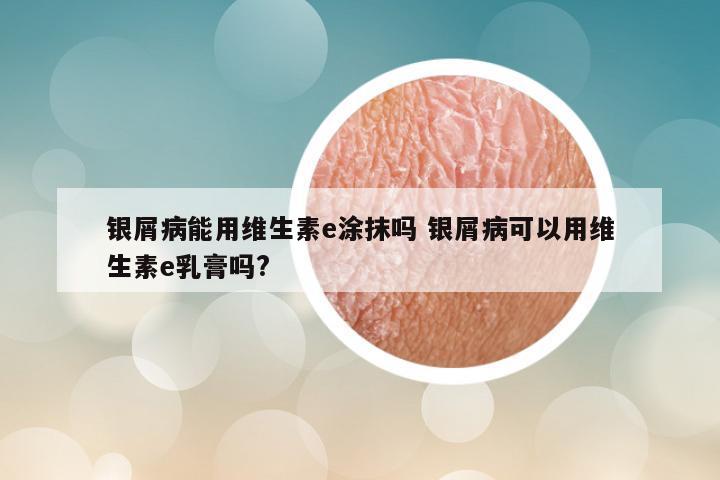 银屑病能用维生素e涂抹吗 银屑病可以用维生素e乳膏吗?