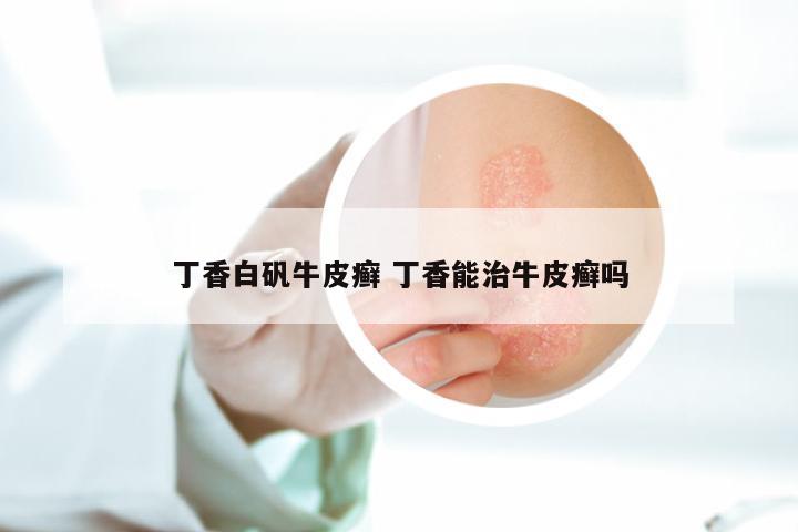 丁香白矾牛皮癣 丁香能治牛皮癣吗