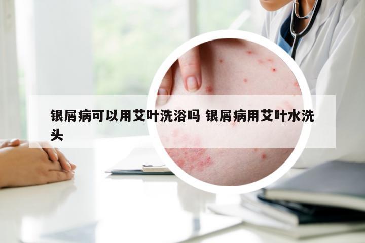 银屑病可以用艾叶洗浴吗 银屑病用艾叶水洗头