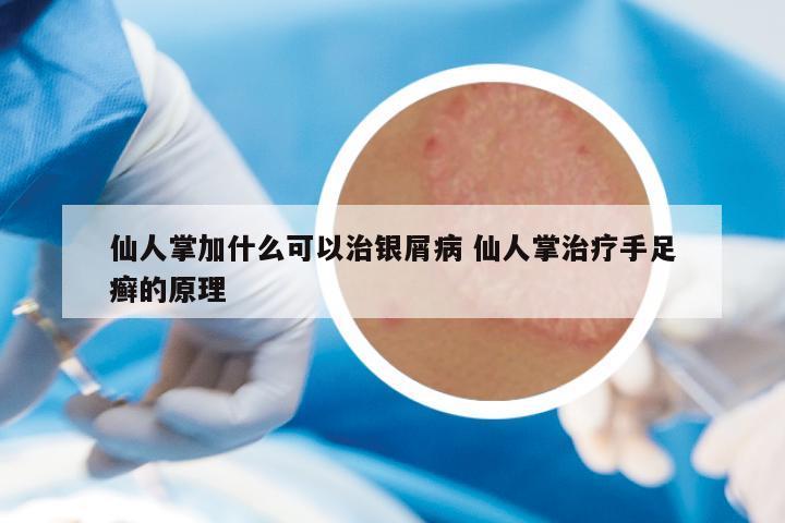 仙人掌加什么可以治银屑病 仙人掌治疗手足癣的原理