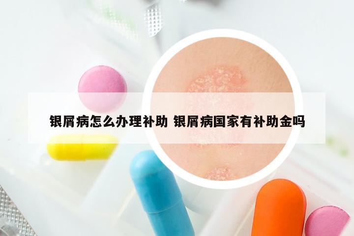 银屑病怎么办理补助 银屑病国家有补助金吗