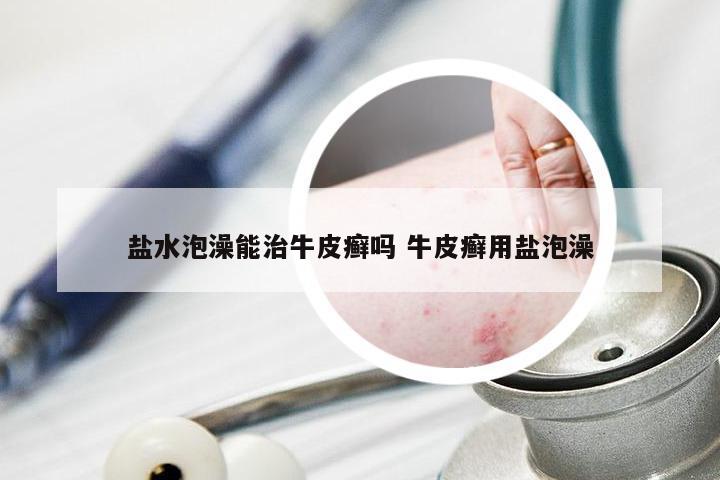 盐水泡澡能治牛皮癣吗 牛皮癣用盐泡澡