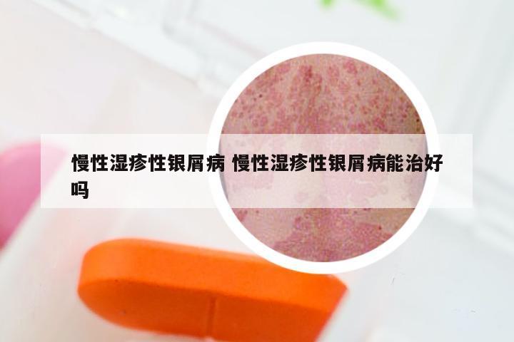 慢性湿疹性银屑病 慢性湿疹性银屑病能治好吗