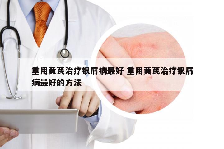 重用黄芪治疗银屑病最好 重用黄芪治疗银屑病最好的方法
