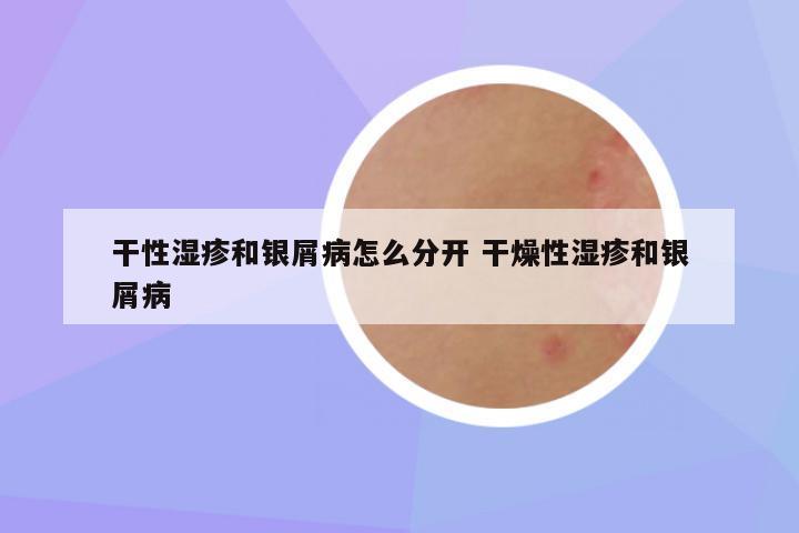干性湿疹和银屑病怎么分开 干燥性湿疹和银屑病