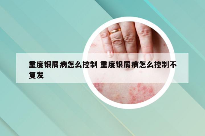 重度银屑病怎么控制 重度银屑病怎么控制不复发