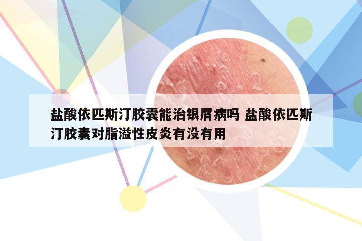 盐酸依匹斯汀胶囊能治银屑病吗 盐酸依匹斯汀胶囊对脂溢性皮炎有没有用
