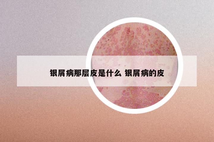 银屑病那层皮是什么 银屑病的皮