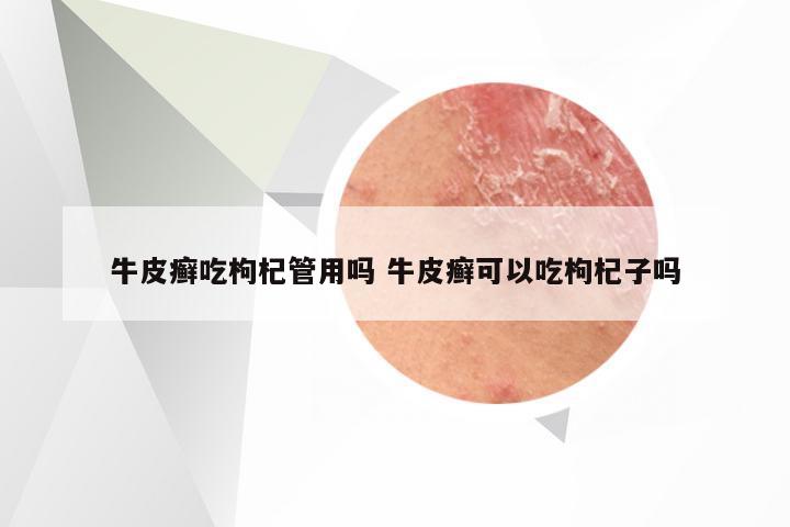 牛皮癣吃枸杞管用吗 牛皮癣可以吃枸杞子吗
