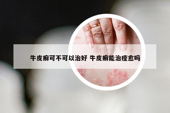 牛皮癣可不可以治好 牛皮癣能治痊愈吗