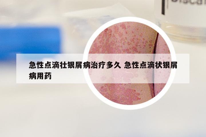 急性点滴壮银屑病治疗多久 急性点滴状银屑病用药