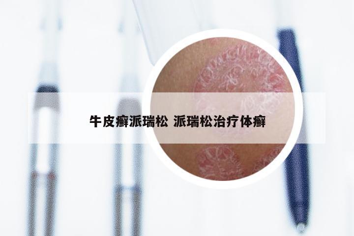 牛皮癣派瑞松 派瑞松治疗体癣