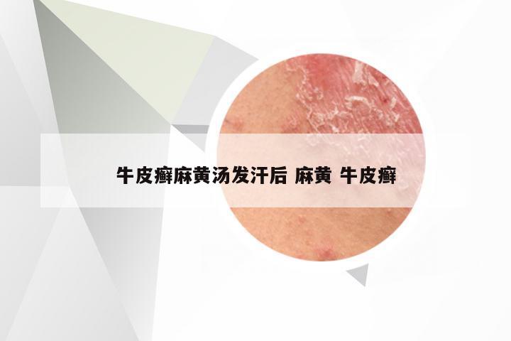 牛皮癣麻黄汤发汗后 麻黄 牛皮癣