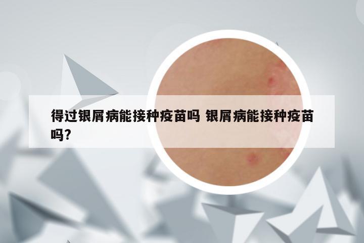 得过银屑病能接种疫苗吗 银屑病能接种疫苗吗?