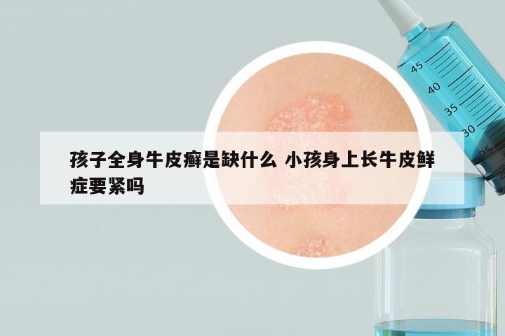 孩子全身牛皮癣是缺什么 小孩身上长牛皮鲜症要紧吗