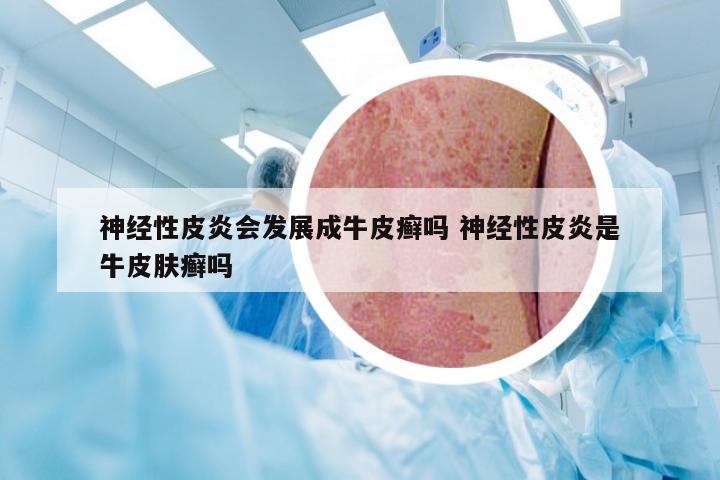 神经性皮炎会发展成牛皮癣吗 神经性皮炎是牛皮肤癣吗