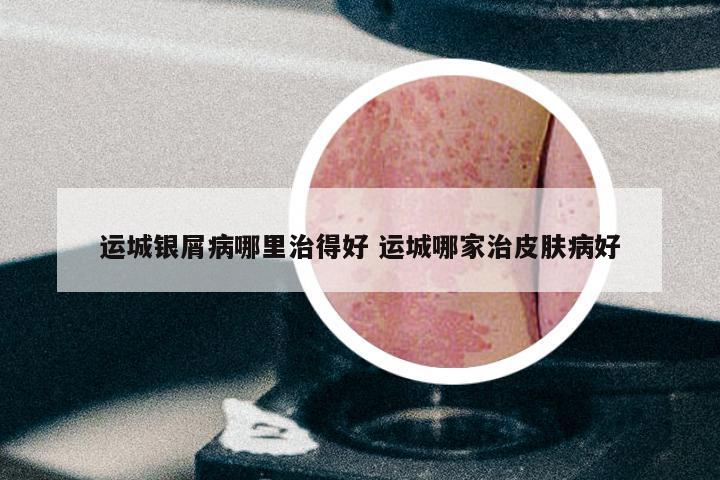 运城银屑病哪里治得好 运城哪家治皮肤病好