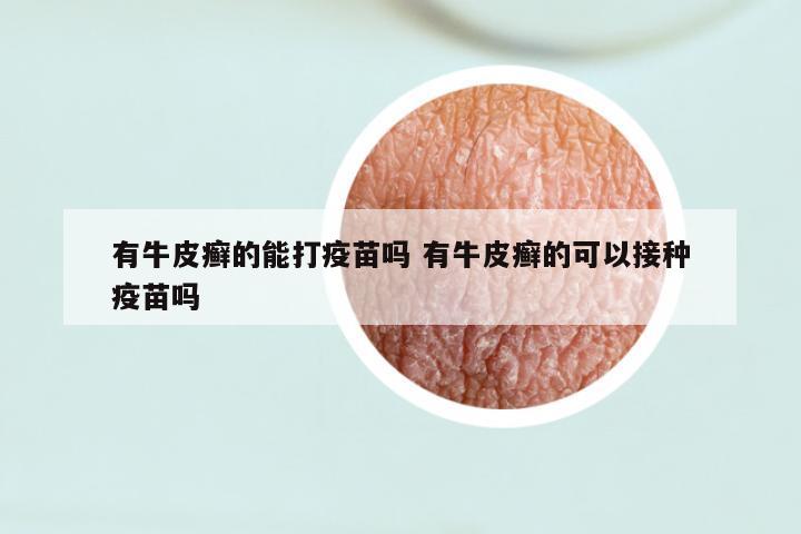 有牛皮癣的能打疫苗吗 有牛皮癣的可以接种疫苗吗