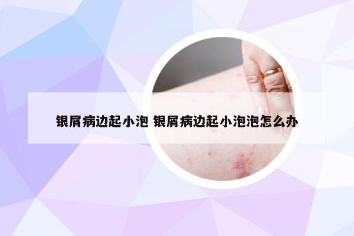银屑病边起小泡 银屑病边起小泡泡怎么办