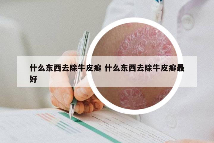 什么东西去除牛皮癣 什么东西去除牛皮癣最好
