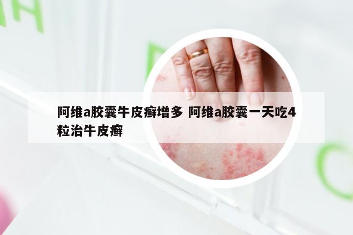 阿维a胶囊牛皮癣增多 阿维a胶囊一天吃4粒治牛皮癣
