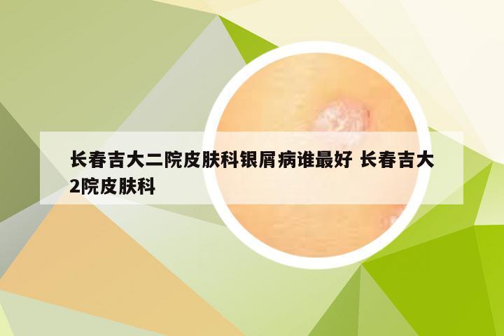 长春吉大二院皮肤科银屑病谁最好 长春吉大2院皮肤科